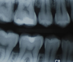 Xray