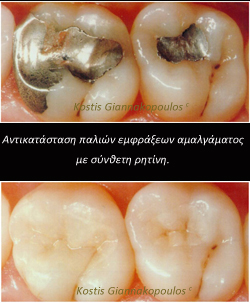 amalgam to composite
