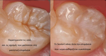Pit and Fissure Sealant 2
